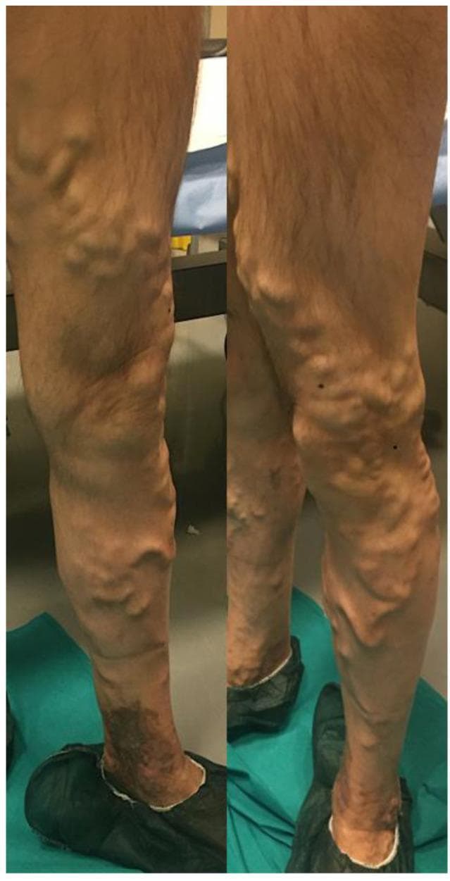 A preoperative clinical photograph showing the posterior and medial views of a lower left limb with severe chronic venous insufficiency. The image demonstrates extensive varicose veins involving the great saphenous vein distribution and its collateral branches. The veins appear markedly enlarged, tortuous, and protuberant, extending from the distal thigh through the popliteal region and down to the mid-calf. In the lower calf and ankle region, there is significant hyperpigmentation and skin discoloration consistent with venous stasis dermatitis or lipodermatosclerosis. The morphology of the veins is characteristic of advanced primary or secondary varicosities, indicating venous hypertension. This visual serves as an educational example of advanced peripheral vascular disease, highlighting the physical examination findings of varicosity, tortuosity, and secondary cutaneous changes associated with chronic venous stasis.
