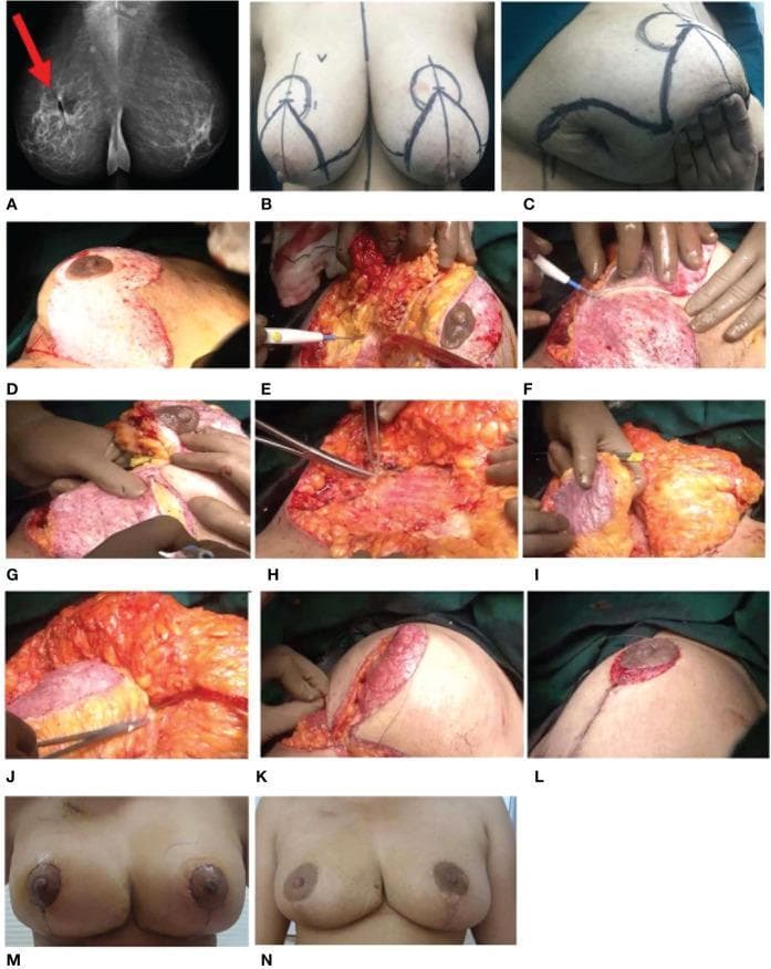 A multi-panel series documenting a case of 'Extreme Therapeutic Mammoplasty' (TM) for breast cancer management. Panel A displays a pre-operative 2D bilateral mammogram in the Mediolateral Oblique (MLO) view, identifying an ill-defined, spiculated lesion in the right upper deep central quadrant and an enlarged axillary lymph node. Panel B and C show pre-operative surgical markings and a previous lumpectomy scar. Panels D through L detail the intra-operative oncoplastic procedure, showcasing de-epithelialization of the infero-medial pedicle, wide local excision of the tumor with a skin island, and the identification of a dual-pedicle system. The images demonstrate the use of the superomedial pedicle for the nipple-areolar complex (NAC) and the mobilization of the inferior pedicle as a volume filler to correct the excision defect. Clipping of the tumor bed for radiotherapy targeting is visible. Panels M and N provide longitudinal post-operative follow-up at one month and one year, demonstrating the final aesthetic and structural outcome of the breast reconstruction.