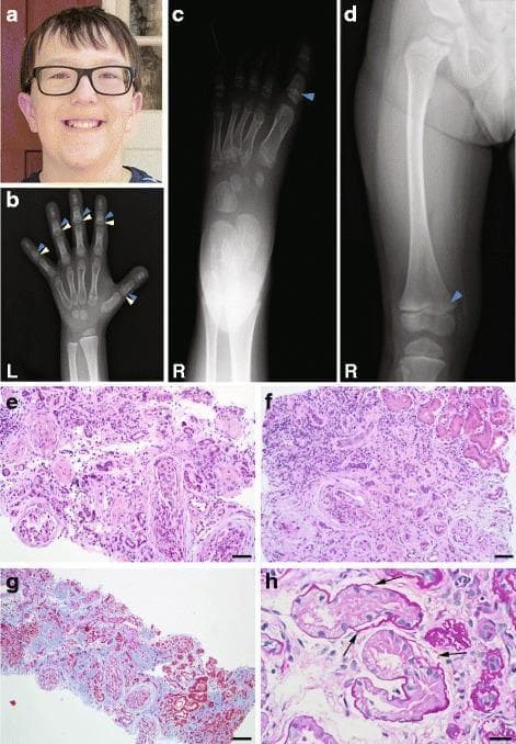 Educational panel illustrating skeletal and renal manifestations of a ciliopathy, likely Mainzer-Saldino syndrome.
