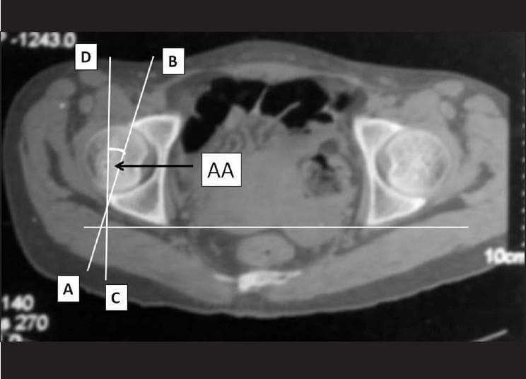 This diagnostic image is an axial computed tomography (CT) scan of the human pelvis at the level of the acetabulum, demonstrating the radiographic measurement of acetabular anteversion (AA). The scan shows the bilateral hip joints, including the femoral heads and the surrounding acetabular walls. Overlaying the right acetabulum (anatomically the patient's right, left on the image), several reference lines are drawn: Line AB connects the anterior and posterior acetabular margins, representing the orientation of the acetabular opening. Lines C and D are vertical reference lines aligned with the sagittal plane of the pelvis. The acute angle formed between the acetabular line (AB) and the sagittal reference line (CD) is labeled 'AA', indicating the degree of acetabular anteversion. This measurement is clinically significant in orthopedic surgery and radiology for evaluating hip joint morphology, diagnosing impingement or dysplasia, and planning total hip arthroplasty to ensure stable component positioning.