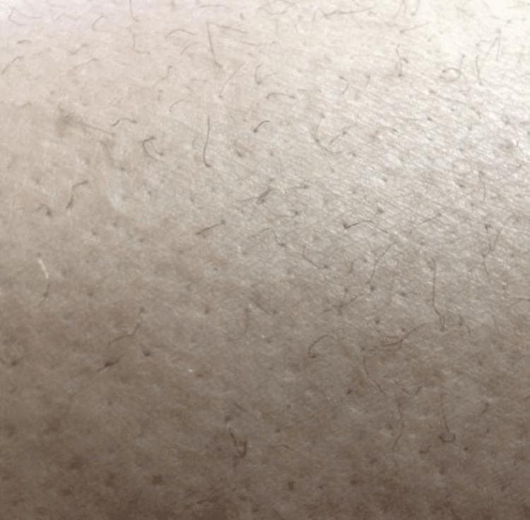 Clinical photograph of a skin surface, likely from the lower extremity, showing characteristic dermatological findings of scurvy (Vitamin C deficiency). The image displays 'corkscrew hairs,' which are hair shafts that appear abnormally coiled, twisted, and fragile in a spiral or helical pattern. Additionally, there is evidence of follicular hyperkeratosis and perifollicular changes, where the skin around the hair follicles appears slightly raised and textured. These visual markers are classic pathognomonic signs used in the diagnosis of ascorbic acid deficiency, often occurring alongside other systemic symptoms like ecchymosis and gingival changes. The educational focus is on identifying specific hair morphology associated with nutritional deficiencies and metabolic disorders.