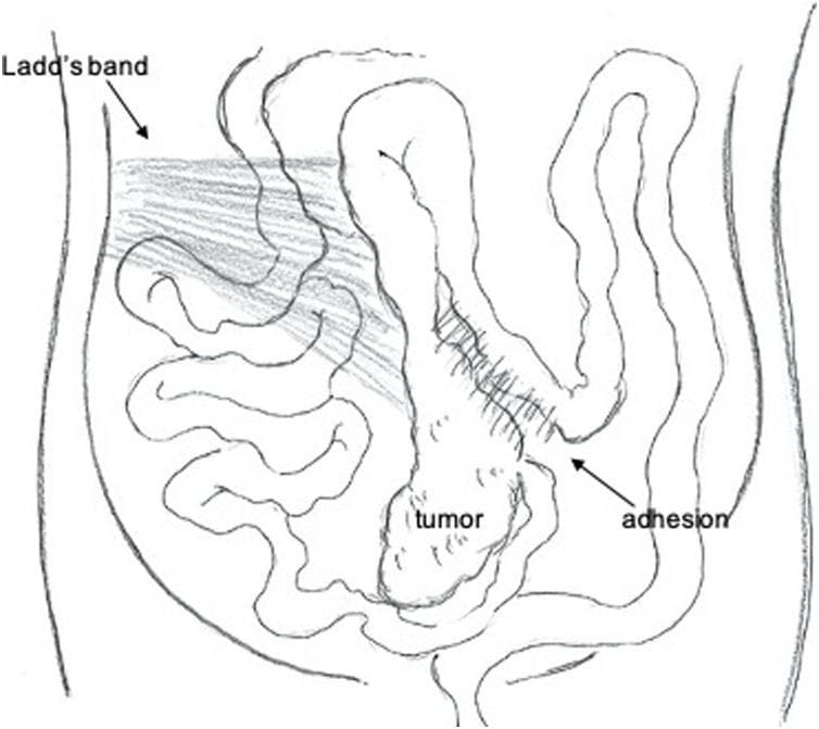 An anatomical line drawing illustrating the intraoperative findings of intestinal malrotation (non-rotation type) within the abdominal cavity. The illustration depicts the small intestine predominantly sequestered on the right side of the abdomen. The ascending colon and cecum are notably displaced from their typical retroperitoneal position and are instead located along the midline. Key pathological structures are labeled: 'Ladd's band' is shown as a fibrous band of peritoneum crossing the small bowel loops; a 'tumor' is identified in the ileocecal/appendiceal region along the midline; and an 'adhesion' is marked connecting the tumor region to the adjacent transverse colon. The diagram effectively demonstrates the abnormal anatomical relationship between the midgut structures and the lack of standard colonic fixation, common in adult presentations of congenital malrotation complicated by malignancy.