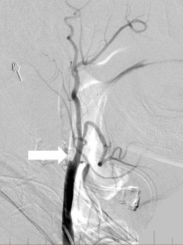 This lateral view digital subtraction angiography (DSA) image demonstrates the right extracranial carotid arterial system. The contrast-filled right common carotid artery (RCCA) is visible at the inferior aspect of the image. A white arrow points to the bifurcation, where there is an abrupt cessation of contrast flow into the internal carotid artery (ICA), indicating a complete proximal occlusion at the level of the carotid bulb. In contrast, the external carotid artery (ECA) and its distal facial and superficial temporal branches remain patent and well-opacified. The imaging is consistent with a cervical ICA occlusion, often secondary to atherosclerotic disease or dissection. This diagnostic image is used in neurointerventional radiology to evaluate the source of acute ischemic stroke symptoms, such as left-sided weakness and dysarthria, and to plan revascularization procedures like thrombectomy or stenting.