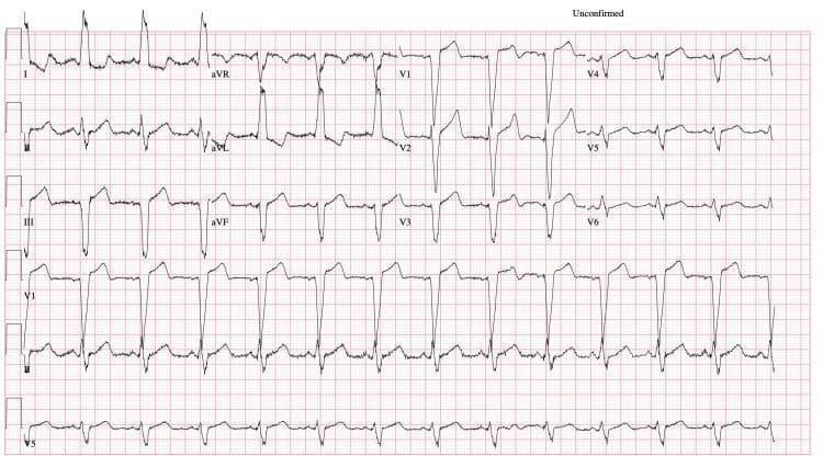 A 12-lead electrocardiogram (ECG) displayed on standard pink grid paper, demonstrating normal sinus rhythm with significant conduction abnormalities. The diagnostic hallmark is a Left Bundle Branch Block (LBBB), characterized by a markedly widened QRS complex exceeding 120ms (specifically 158ms per context). Notable morphology includes broad, notched, or 'M-shaped' R-waves in the lateral leads (I, aVL, V5, and V6) and deep S-waves in the right precordial leads (V1-V3). There is evidence of left axis deviation, with predominantly positive deflections in lead I and negative deflections in leads II and III. ST-segment and T-wave discordance is visible, where the ST-segments and T-waves shift in the opposite direction of the main QRS vector, a common secondary repolarization finding in LBBB. This diagnostic image is intended for medical education regarding cardiac conduction system delays and intraventricular blocks. The ventricular rate is approximately 78 bpm, and the QTc interval is prolonged at 533 ms.