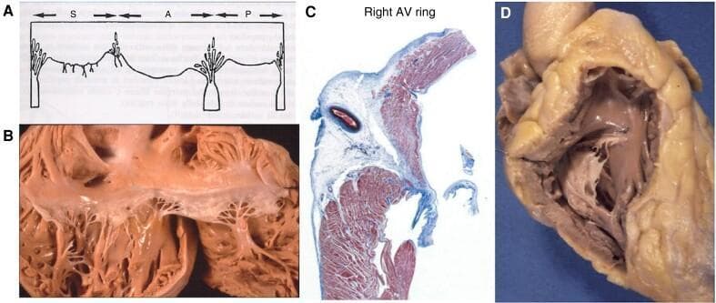 This composite image illustrates the gross and microscopic anatomy of the human tricuspid valve and right ventricular structures. (A) Line diagram showing the topographical layout of the septal (S), anterior (A), and posterior (P) leaflets. (B) Gross clinical photograph of an explanted tricuspid valve, highlighting the complex subvalvular apparatus; visible are the fan-like chordae tendineae extending from the Lancisi and anterior papillary muscles to the translucent valve leaflets. (C) Histological cross-section (likely Masson's trichrome stain) of the Right Atrioventricular (AV) ring, showing the fibrous annulus (stained blue/white) where the valve leaflet inserts between the right atrial and ventricular myocardium (stained red). A vascular structure is visible within the fibrous tissue. (D) Gross photograph of the right ventricular outflow tract demonstrating the trabecula septomarginalis (moderator band), conal papillary muscle, and the relationship between the anterior papillary muscle and ventricular walls. This collection serves as an educational resource for cardiology and cardiac surgery trainees focusing on valvular morphology and anatomical landmarks.