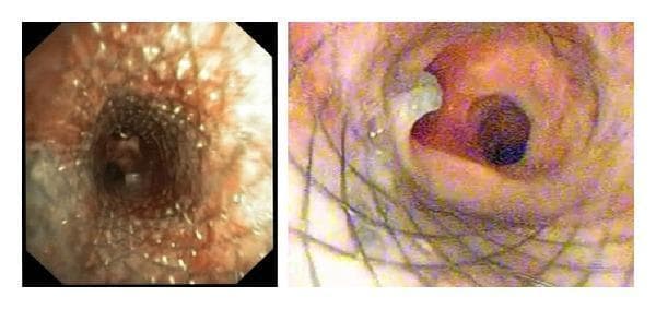 Two-panel bronchoscopic clinical photograph showing the management of a tracheoesophageal fistula (TEF). The left panel displays a diagnostic view of the tracheal lumen, where a previously placed esophageal self-expanding metallic stent (SEMS) has eroded through the posterior tracheal wall, evidenced by the visible wire mesh protruding into the airway and causing tissue irregularity. The right panel demonstrates the post-procedural outcome following the successful deployment of a covered tracheal SEMS. This second stent successfully bridges and seals the TEF and the site of erosion. The lumen of the newly placed covered stent is patent, with a smooth internal surface that restores airway integrity and isolates the trachea from the esophageal defect. The surrounding tracheal mucosa shows mild reactive erythema and inflammation consistent with chronic irritation from the fistula and metallic hardware.