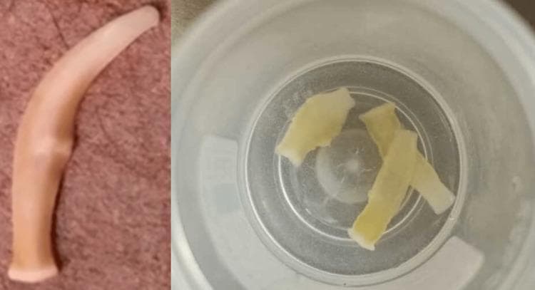 This clinical photograph displays macroscopic specimens of ivory-colored, ribbon-like worm segments isolated from a human stool sample. The image is divided into two panels: the left shows a single, elongated, and slightly curved proglottid with a smooth, translucent texture and ivory hue, exhibiting a tapered end and a central constriction. The right panel shows several similar segments collected in a clear specimen container; these fragments are flattened, rectangular to irregular in shape, and pale yellow-white, consistent with Taenia saginata (beef tapeworm) proglottids. This visual illustrates the macroscopic presentation of taeniasis, a parasitic infection typically acquired through the consumption of undercooked beef containing cysticerci. The presence of motile or stationary segments in feces is a pathognomonic clinical sign, often accompanied by perianal itching or mild abdominal discomfort. The image serves as an educational reference for medical parasitology and gastrointestinal infectious diseases, highlighting the importance of macroscopic stool examination when microscopic wet mounts for eggs are negative.