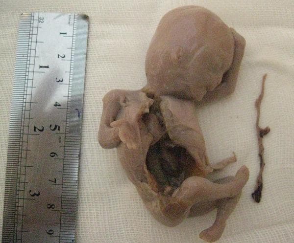 This clinical photograph shows a second-trimester human fetus alongside a metric ruler, documenting a case of intrauterine fetal death (IUFD) associated with Thin Cord Syndrome (TCS). The fetus exhibits signs of post-mortem maceration, including diffuse brownish skin discoloration and tissue softening. An open thoracic and abdominal cavity reveals internal organs undergoing ischemic necrosis. Positioned to the right of the fetus is a segment of the umbilical cord, which is notably pathological; it appears extremely thin, shriveled, and dark, measuring approximately 1 mm in diameter. This morphology indicates a severe deficiency of Wharton’s jelly, a condition that can lead to cord constriction, vascular compromise, and subsequent fetal demise. The presence of the ruler provides a scale for the approximately 9 cm long, filamentous cord. This image is an educational example for obstetrics and pathology, illustrating rare umbilical cord abnormalities and the macroscopic features of fetal death at 21 weeks of gestation.