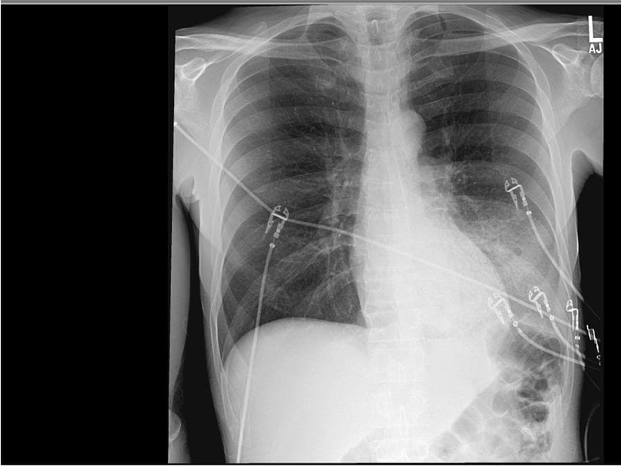 This diagnostic image is an anteroposterior (AP) chest X-ray demonstrating a significant dense consolidation in the left lower lobe. The primary finding is an area of increased opacity in the left paracardiac and retrocardiac region, which partially obscures the left hemidiaphragm and lower mediastinal border, consistent with lobar pneumonia or an inflammatory infiltrate. The right lung field appears clear without evidence of effusion or focal consolidation. Multiple medical devices are visible overlying the thorax, including radiopaque ECG leads and associated wires distributed across both lung fields. The cardiac silhouette appears within normal limits for an AP projection, and the bony structures, including the ribs and clavicles, are intact. This radiographic presentation is typical for acute infectious processes such as Legionella pneumonia, as suggested by the clinical context. The image serves as a key educational example of lobar consolidation and the visual identification of indwelling monitoring equipment in an acute clinical setting.