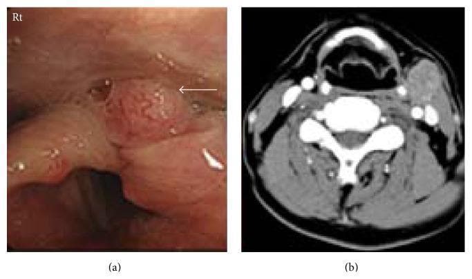 This dual-panel image displays diagnostic findings for hypopharyngeal squamous cell carcinoma. Panel (a) is an endoscopic clinical photograph of the laryngopharynx, showing a pinkish-red, irregular mass lesion located in the left piriform recess (indicated by a white arrow). The lesion exhibits a nodular surface texture characteristic of malignancy. Panel (b) is an axial contrast-enhanced computed tomography (CT) scan of the neck at the level of the larynx. It demonstrates a primary soft-tissue mass in the left hypopharyngeal region and a corresponding enlarged, contrast-enhancing metastatic cervical lymph node on the left side (Level II/III). The lymph node appears oval with increased density compared to adjacent muscular structures. Together, these images illustrate the primary site and regional lymphatic spread of Stage IVa hypopharyngeal cancer, highlighting the role of endoscopy and cross-sectional imaging in oncological staging and diagnosis within otorhinolaryngology.