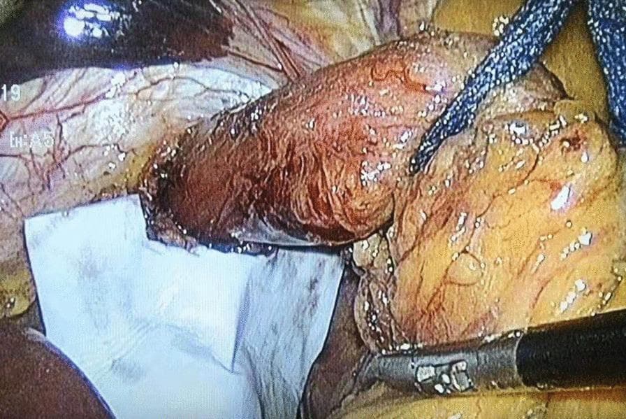 This clinical photograph captures a laparoscopic surgical field during a cruroplasty for hiatal hernia repair. The central focus is the intraoperative placement of a bioabsorbable surgical mesh (biological prosthesis) for reinforcement of the diaphragmatic crura. The mesh appears as a rectangular, opaque white, flexible sheet positioned at the base of the esophageal hiatus. A laparoscopic grasper with a silver metallic tip and black shaft is visible at the bottom right, used to manipulate the mesh and underlying tissue. Adjacent to the mesh is the reddish-brown muscular tissue of the diaphragm and the gastroesophageal junction. A blue braided suture is visible near the top right, and clear medical adhesive (cyanoacrylate) has been applied to fix the mesh in place. The image demonstrates the anatomical relationship between the prosthetic reinforcement and the esophageal hiatus, highlighting surgical techniques for strengthening hiatal closure in foregut surgery.