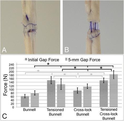 This composite educational resource consists of clinical photographs and a comparative bar chart demonstrating the biomechanical properties of different tendon repair techniques. Panel A shows a clinical photograph of a tendon repaired with a Bunnell suture pattern, displaying the characteristic ladder-like, horizontal dark blue suture passes across the pale fibrous tissue. Panel B illustrates a 5-mm gap formation between the proximal and distal tendon segments under mechanical stress, highlighting the vertical stretching of the core suture material. Panel C is a quantitative bar graph comparing 'Initial Gap Force' and '5-mm Gap Force' (measured in Newtons) across four surgical techniques: standard Bunnell, Tensioned Bunnell, Cross-lock Bunnell, and Tensioned Cross-lock Bunnell. The graph indicates that pretensioning and cross-locking configurations significantly increase the resistance to gap formation compared to the standard Bunnell technique. This content is designed for orthopaedic surgical education, focusing on tendon repair strength, suture morphology, and biomechanical failure thresholds.
