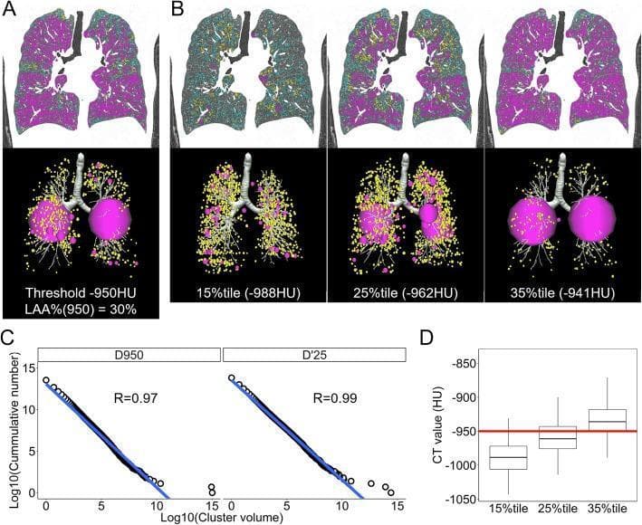 This composite educational image illustrates quantitative CT analysis of emphysematous lung destruction using low attenuation area (LAA) cluster modeling. Panel A shows a coronal CT section and corresponding 3D sphere model based on a fixed threshold of -950 Hounsfield Units (HU), highlighting localized large clusters (pink spheres, >500 mm³). Panel B presents a comparison of percentile-based thresholds (15th, 25th, and 35th percentiles), demonstrating how different density cut-offs capture varying distributions of moderate (yellow spheres, 50-499 mm³) and small LAA clusters throughout the pulmonary parenchyma. Panel C contains log-log plots showing the linear relationship between LAA cluster volume and cumulative frequency, used to derive the fractal dimension (D), a measure of structural complexity in COPD. High correlation coefficients (R=0.97-0.99) indicate a strong power-law distribution. Panel D is a box plot showing the distribution of CT values corresponding to the 15th, 25th, and 35th percentiles across a study cohort, with a reference line at -950 HU. This material is designed for advanced medical imaging and pulmonology education regarding automated quantification of emphysema progression.