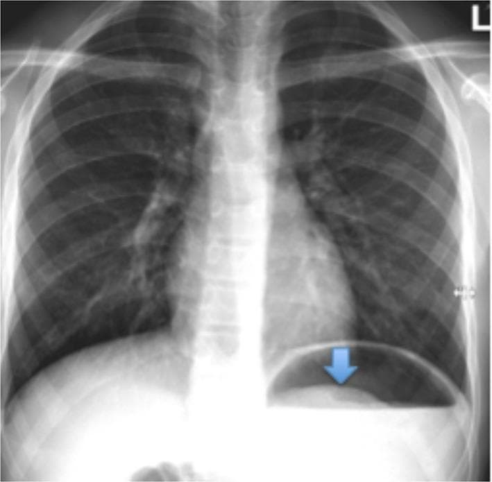 This diagnostic image is a posterior-anterior (PA) chest radiograph. The thoracic anatomy including the lungs, cardiac silhouette, and mediastinum appears within normal limits with no evidence of pulmonary opacities or lymphadenopathy. A blue arrow highlights the primary clinical finding in the left upper quadrant of the abdomen, just below the left diaphragm. Specifically, a large gastric air bubble is visible containing a curvilinear, soft-tissue density shadow projecting into the gas space. This appearance is characteristic of a gastric bezoar (trichobezoar), representing solid ingested material outlined by a rim of gastric air. The absence of free air under the diaphragm (pneumoperitoneum) suggests there is no gastric perforation. The image serves as an educational example of how abdominal pathology can be incidentally identified or subtly present on the lower portion of a standard chest X-ray.
