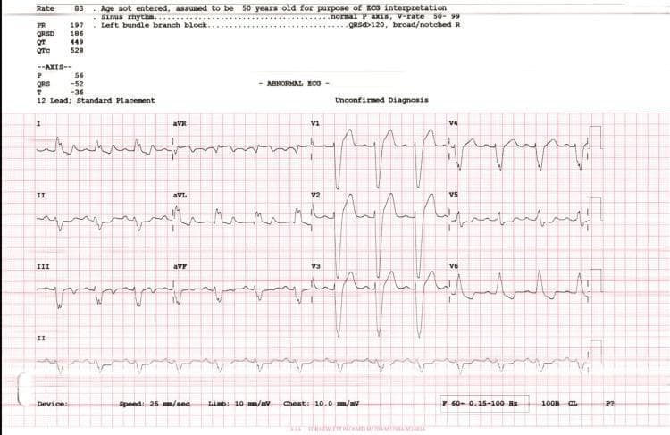 This diagnostic image is a 12-lead electrocardiogram (ECG) performed at standard placement, demonstrating normal sinus rhythm with findings classic for a complete left bundle branch block (LBBB). The tracing shows a wide QRS complex (QRSD measured at 186 ms) with a leftward axis (QRS axis of -52 degrees). Key morphological features include broad, notched 'M-shaped' R waves in the lateral leads (I, aVL, V5, and V6) and deep, wide S waves in the right precordial leads (V1-V3). There is a concurrent prolongation of the QTc interval (528 ms) and secondary ST-T wave changes, specifically T-wave inversion in the lateral leads, which are expected in the context of altered ventricular depolarization. This ECG is a critical educational example for identifying conduction delays in the setting of heart failure or cardiomyopathies, such as non-compaction cardiomyopathy, where left ventricular dysfunction is often accompanied by significant intraventricular conduction disturbances.