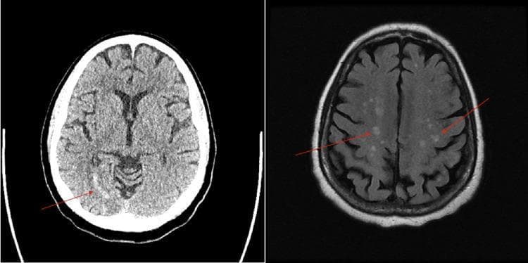 This composite diagnostic image features two axial views of the brain: a non-contrast Computed Tomography (CT) scan on the left and a Magnetic Resonance Imaging (MRI) sequence on the right. The CT scan demonstrates a localized area of hypoattenuation (low density) in the right posterior cerebral artery (PCA) territory, specifically within the occipital lobe, marked by a red arrow, which is characteristic of an acute to subacute ischemic infarction. The MRI scan (FLAIR or T2-weighted sequence) reveals multiple, scattered, small hyperintense foci throughout the subcortical white matter and cortical regions of both cerebral hemispheres, indicated by red arrows. This widespread, multifocal distribution of lesions is highly suggestive of an embolic process, such as septic emboli or cardiogenic thromboembolism. These images provide a comparison between CT and MRI modalities in detecting ischemic changes and characterizing embolic stroke patterns in a clinical neurology context.