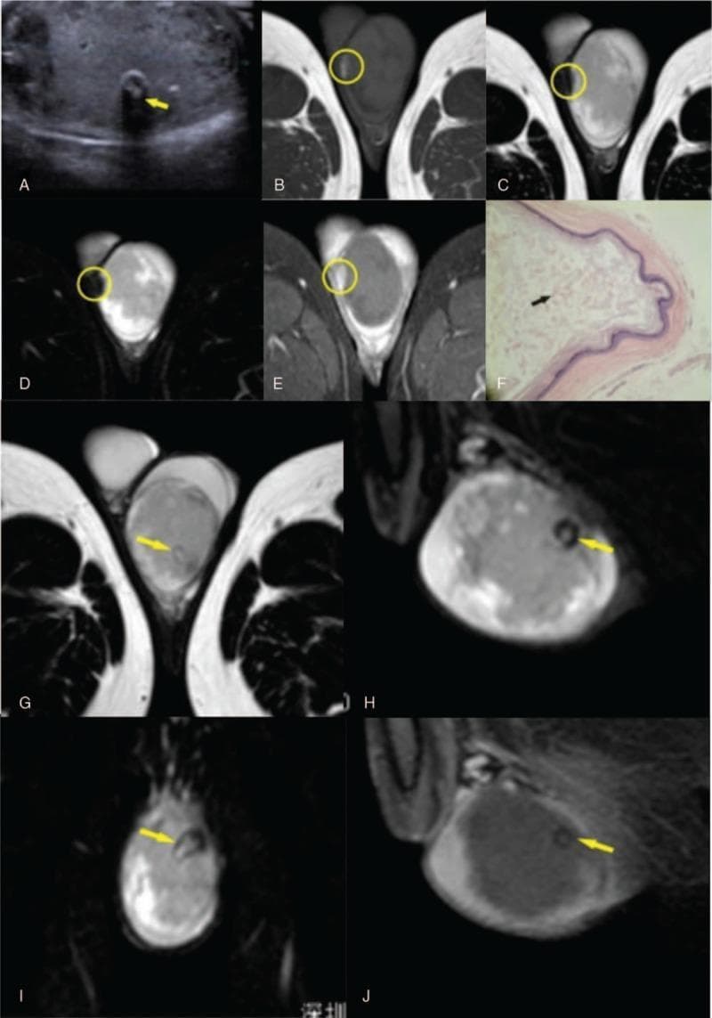 Multi-modal imaging and histopathology of an atypical Testicular Epidermoid Cyst (TEC) in a 26-year-old male. (A) Scrotal ultrasonography displays a large, heterogeneous intratesticular mass with a central focus of hyperechogenicity and significant posterior acoustic shadowing (yellow arrow), suggesting calcification. (B-E) Multi-sequence MRI of the scrotum shows a well-defined mass. A mural nodule (yellow circle) appears hyperintense on T1-weighted imaging (B) and hypointense on T2-weighted (C) and SPAIR (D) sequences. Post-contrast THRIVE sequence (E) demonstrates gadolinium enhancement of the nodule, indicating vascularity. (F) Histopathology (H&E, 20x) reveals a cyst wall with keratinized epithelium and a disorderly internal accumulation of keratin (black arrow), lacking the classic 'onion-skin' arrangement. (G-J) Focused MRI sequences highlight a 'small black ring sign' on T2-weighted and SPAIR images (yellow arrows), which remains non-enhanced on post-contrast THRIVE imaging (J), consistent with a calcified component. This case demonstrates atypical radiological features of TEC, including the absence of alternating concentric rings and the presence of a vascularized mural nodule.