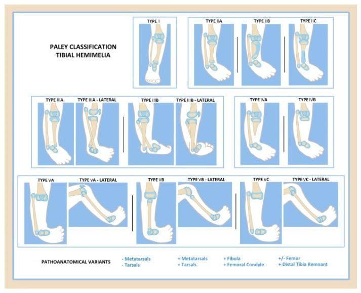 This medical illustration presents the Paley classification system for tibial hemimelia, a congenital lower limb deficiency. The diagram categorizes the condition into five primary types (I-V) based on the degree of tibial deficiency and associated joint anomalies, with several subtypes. Type I illustrates a hypoplastic but present tibia. Type II (A-C) shows various distal tibial dysplasias, including delta tibia and cartilaginous anlagen. Type III (A-B) demonstrates distal tibiofibular diastasis with a missing tibial plafond. Type IV (A-B) depicts distal tibial aplasia where only a proximal tibial remnant exists. Type V (A-C) represents complete tibial aplasia, further classified by the presence or absence of the patella and quadriceps function. Lateral views accompany several types to show the sagittal alignment of the knee and the equinovarus positioning of the foot. The illustration serves as a diagnostic and surgical planning tool for pediatric orthopedics, highlighting the relationship between the remnant tibia, the fibula, and the foot position.