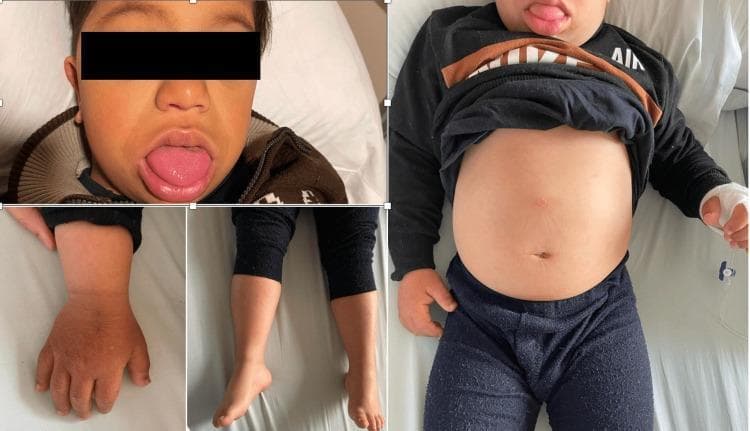 A composite clinical photograph showing physical manifestations of severe hypothyroidism or myxedema in a pediatric patient. The facial view reveals generalized puffiness (myxedematous facies) and a protruding, enlarged tongue (macroglossia). The skin appears dry and slightly thickened. The trunk view demonstrates a markedly distended abdomen, suggestive of ascites or organomegaly related to the metabolic state. Lower extremity images show non-pitting edema and thin legs relative to the central adiposity/distension. A close-up of the hand shows dry, rough skin with mild hyperpigmentation. Collectively, these features illustrate the classic systemic findings of myxedematous infiltration affecting the integumentary and musculoskeletal systems in congenital or early-onset hypothyroidism.