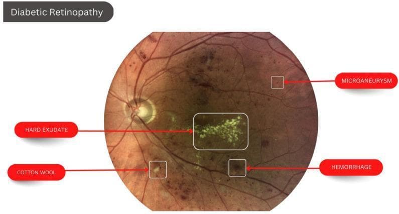 This clinical fundus photograph illustrates the classic ocular manifestations of diabetic retinopathy. The image displays a posterior view of the retina with several labeled pathological lesions. Key clinical findings identified include: 1) Hard Exudates: clustered, yellowish-white lipid deposits with distinct borders located in the macular region; 2) Microaneurysms: small, punctate red dots representing localized capillary dilatations; 3) Retinal Hemorrhages: larger, dark red blotches indicating blood leakage within the retinal layers; and 4) Cotton Wool Spot: a fluffy, pale-white lesion with indistinct margins signifying an area of nerve fiber layer infarction. The background shows an orange-red retinal hue with visible major retinal arteries and veins emanating from the optic disc. This visual is designed for educational indexing in ophthalmology to demonstrate non-proliferative diabetic retinopathy features and their typical distribution patterns within the fundus.