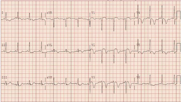 A 12-lead electrocardiogram (ECG) tracing presented on a standard grid format. The tracing demonstrates a regular sinus rhythm with visible P waves preceding each QRS complex. Significant diagnostic findings include ST-segment elevation predominantly visible in the precordial leads (V1-V4), suggesting acute myocardial injury. Additionally, there are prominent, symmetric T-wave inversions observed across the precordial leads (V1-V6) and lateral leads (I, aVL), which are often indicative of myocardial ischemia or reperfusion. The QRS complexes are relatively narrow with normal morphology, and the electrical axis is unremarkable. This ECG illustrates a typical presentation of acute coronary syndrome (ACS) or myocardial infarction (MI) affecting the anterior and lateral walls of the heart. The material is suitable for cardiovascular education focusing on the recognition of ST-elevation myocardial infarction (STEMI) patterns and ischemic T-wave changes.