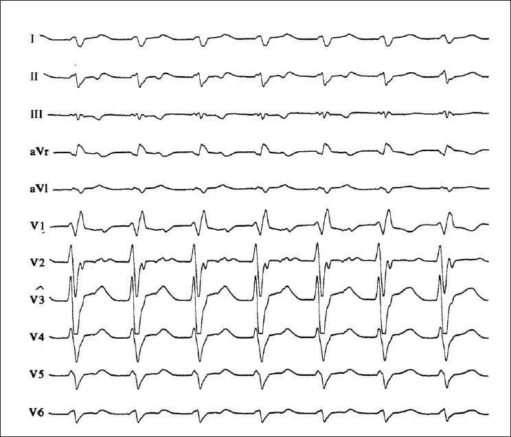 A 12-lead electrocardiogram (ECG) demonstrating monomorphic wide-QRS complex tachycardia. The tracing shows a rapid, regular rhythm with diagnostic features of ventricular tachycardia (VT). Key morphological findings include a Right Bundle Branch Block (RBBB) pattern, specifically characterized by a triphasic (rsR') QRS complex in lead V1 and an R to S ratio of less than 1 in lead V6 (dominant S wave). The axis is oriented toward the 'northwest' quadrant (extreme right axis deviation), visualized as predominantly negative QRS complexes in leads I and aVF. Additionally, evidence of AV dissociation is present, which is a highly specific hallmark for differentiating ventricular tachycardia from supraventricular tachycardia with aberrancy. The precordial leads show a progression from dominant R waves in V1-V4 to dominant S waves in V5-V6. This clinical image serves as an educational example of cardiac arrhythmia diagnosis and the application of Brugada or Vereckei criteria in emergency cardiology.