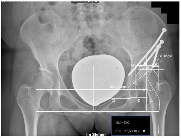 This diagnostic image is an anteroposterior (AP) pelvic radiograph demonstrating the outcome of a left-sided Periacetabular Osteotomy (PAO), a surgical procedure for hip dysplasia. The radiograph shows the pelvic girdle, proximal femurs, and sacrum. On the left hip, evidence of surgical intervention includes three large cortical screws utilized for internal fixation of the acetabular fragment into the ilium. The reconstructed acetabulum shows improved femoral head coverage. Detailed orthopedic measurements are overlaid on the image to quantify postoperative alignment, including the Center-Edge (CE) angle (38.0°), Acetabular Index (AI) angle (-0.5°), and Sharp angle (36.5°). Additional metrics include the Hip Lateralization Index (HLI = D/C, 0.56), Anterior Hip Index (AHI = A/(A+B) x 100, 91.4), and the Caput-Collum-Diaphyseal (CCD) angle (137.4°). A positive 'crossing-over sign' is noted, indicating acetabular retroversion or specific rim morphology post-correction. This clinical image serves as an educational tool for evaluating acetabular orientation and surgical success in pelvic osteotomy procedures.