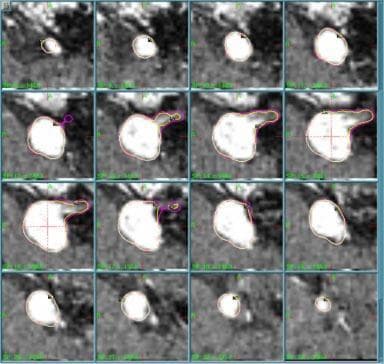 This diagnostic image displays a 4x4 matrix of 16 sequential 1-mm axial MRI slices illustrating a stereotactic radiosurgery treatment plan for an acoustic neuroma (vestibular schwannoma). Each frame shows the anatomical cross-section of the enhancing tumor target, characterized by high-intensity (bright) signal in the cerebellopontine angle. Overlaid on the tumor are two colored contour lines representing different 50% isodose levels (IDL). The outer purple line indicates the planned 50% IDL using standard 4-mm-helmet output factors (OF4/18 = 0.870), while the inner yellow line represents the modified 50% IDL if the output factor were reduced by 20%. The sequence demonstrates the spatial relationship and minimal dosimetric deviation between the two planning scenarios across the target volume. This clinical visual is utilized in radiation oncology and medical physics to assess the sensitivity of dose distributions to variations in collimator output factors, emphasizing treatment precision and quality assurance in intracranial radiosurgery.
