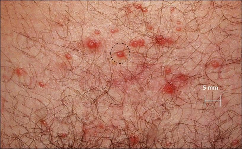 This clinical photograph displays a close-up view of a cutaneous outbreak in a hair-bearing genital region, characteristic of Herpes Simplex Virus type 2 (HSV-2). The primary findings consist of multiple small, erythematous vesicles and shallow round ulcers clustered together. The individual lesions are predominantly less than 5 mm in diameter, as indicated by the accompanying scale bar. The lesions exhibit a spectrum of progression, from intact fluid-filled vesicles (blisters) to open, weeping sores with surrounding inflammatory erythema. A black dotted circle highlights a representative cluster of these spatial features, demonstrating the tendency of the virus to manifest as concurrent, spatially grouped foci of infection. The surrounding skin shows localized inflammation but lacks extensive scarring, suggesting an acute or recurrent shedding episode. This image serves as an educational tool to illustrate the morphology, distribution, and spatial dynamics of genital herpes lesions during a symptomatic reactivation phase.