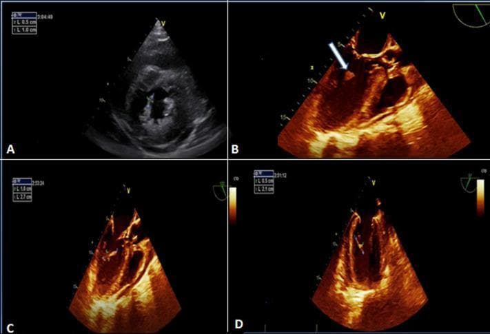 This composite of echocardiographic images demonstrates classic findings of infective endocarditis involving the mitral valve apparatus. Image A is a parasternal short-axis view from a transthoracic echocardiogram (TTE) showing an echogenic, textured mass consistent with vegetation located on the posteromedial mitral valve pillar. Images B, C, and D are transoesophageal echocardiograms (TEE) using a sepia-toned enhancement for improved tissue characterization. These views provide higher resolution of the vegetation, which appears as an irregular, hyper-echogenic, and frond-like mobile structure. In image B, an arrow specifically identifies the vegetation's attachment to the mitral valve apparatus. The diagnostic imaging highlights key features of valvular infection, including vegetation morphology, size assessment (noted in caliber measurements on the screen), and its anatomical relationship to the sub-valvular structures. This material is highly relevant for cardiology and infectious disease training regarding the diagnostic criteria for endocarditis.