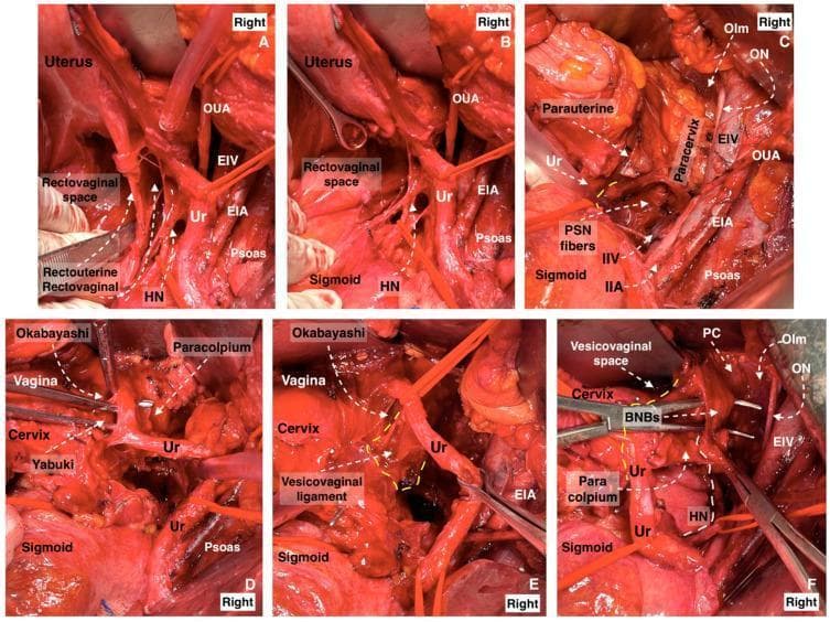 A composite of six clinical photographs (A–F) demonstrating surgical dissection stages of the three parametria during a nerve-sparing radical hysterectomy. The images illustrate the complex pelvic neurovascular and ligamentous anatomy in the right pelvic sidewall. Key structures identified across the panels include the uterus, cervix, vagina, and sigmoid colon. Vascular landmarks include the external iliac artery (EIA) and vein (EIV), internal iliac artery (IIA) and vein (IIV), and the obliterated umbilical artery (OUA). The dissection highlights the ureter (Ur) and its relationship to autonomic nerves, specifically the hypogastric nerve (HN) within the ureterohypogastric fascia, pelvic splanchnic nerve (PSN) fibers, and bladder nerve branches (BNBs). Surgical spaces such as the rectovaginal, Yabuki, and Okabayashi paravaginal spaces are developed to isolate the vesicovaginal ligament and paracervix while preserving the inferior hypogastric plexus. The series demonstrates the precise identification and mobilization of the ureter and paracolpium required to protect pelvic autonomic innervation during oncological resection.