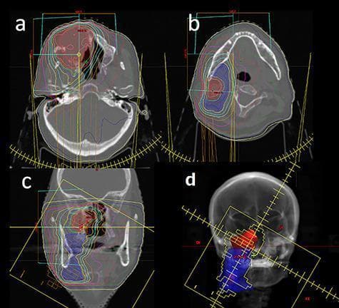 This set of diagnostic images illustrates radiation therapy planning for a head and neck malignancy using Intensity-Modulated Radiotherapy (IMRT). Panels (a) and (b) are axial CT slices showing the primary tumor volume (red mesh) in the maxillary/sinonasal region and the metastatic neck lymph node area (blue mesh) at an inferior level. Panel (c) provides a coronal CT reconstruction, demonstrating the vertical relationship between the superior primary lesion and the inferior nodal chain. Panel (d) displays a 'Beam’s Eye View' (BEV) of the treatment plan, visualizing the spatial orientation and field shaping for the target volumes. Superimposed on the CT images are multicolored isodose lines, with a prominent blue line representing the 95% isodose boundary. The high conformity of these lines around the red and blue target volumes highlights the precision of IMRT in delivering curative doses to the Gross Tumor Volume (GTV) while sparing adjacent critical structures in the head and neck. This visual material is intended for oncology education, focusing on radiotherapy contouring and dose distribution.