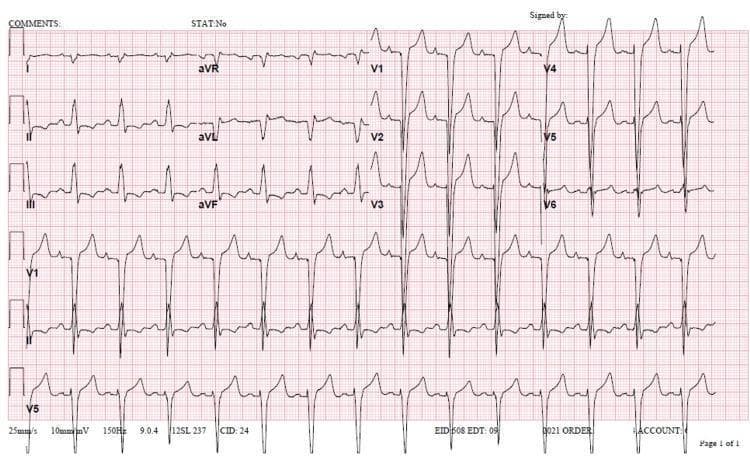 A 12-lead electrocardiogram (ECG) demonstrating a sinus rhythm with significant conduction abnormalities and morphological changes. The rhythm strip shows a heart rate of approximately 82 bpm with identifiable P waves and a PR interval of 180 ms. The QRS complex is markedly widened at 154 ms, exhibiting a morphology consistent with Left Bundle Branch Block (LBBB), characterized by deep S waves in leads V1-V3 and broad, tall R waves in the lateral leads V5 and V6. There is evidence of right axis deviation, which is an atypical finding in the setting of standard LBBB and may suggest concomitant right ventricular hypertrophy or lateral wall infarction. Secondary ST-T wave changes are visible, including T-wave inversions in leads V1 through V6. The QTc interval is prolonged at 500 ms. These findings are clinically relevant for assessing acute myocardial ischemia or cardiomyopathy-related conduction delay in the setting of heart failure.