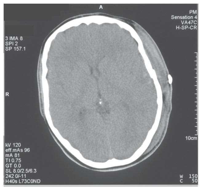 This diagnostic image is a non-contrast axial computed tomography (CT) scan of the head, representing a post-operative follow-up after the evacuation of a left temporoparietal extradural haematoma. The skull appears as a hyperdense peripheral ring, with a small, high-density metallic object visible on the left external scalp surface, likely a surgical staple or marker. The intracranial findings show that while the primary haematoma has been evacuated, residual mass effect is evident by a rightward midline shift and mild effacement of the left lateral ventricle. The brain parenchyma exhibits relatively uniform attenuation, though soft tissue swelling is noted in the left extracranial scalp region, corresponding to the surgical site. This image serves as an educational example of post-neurosurgical radiological assessment, illustrating the transition from an acute compressive lesion (extradural haematoma) to a post-evacuation state with resolving mass effect.