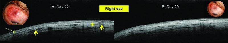 This composite diagnostic image presents a side-by-side comparison of the right eye using clinical photography and Optical Coherence Tomography (OCT) to illustrate the progression of anterior scleritis. Image A (Day 22) demonstrates active pathology: the clinical photograph shows significant scleral injection and localized redness, while the corresponding anterior segment OCT reveals structural disruption. Specifically, dashed arrows indicate separated scleral fibers, solid arrows highlight hyper-reflective inflammatory infiltrates, and an asterisk marks a region of irregular reflectivity within the scleral lamellae. Image B (Day 29) shows the clinical resolution: the external photograph displays a quiet eye with diminished redness, and the OCT scan demonstrates a more homogenous, compact tissue architecture with the disappearance of the previously noted infiltrates and fiber separation. This comparison serves as an educational tool for ophthalmology, specifically for monitoring the clinical and structural response to treatment in inflammatory ocular conditions such as scleritis.