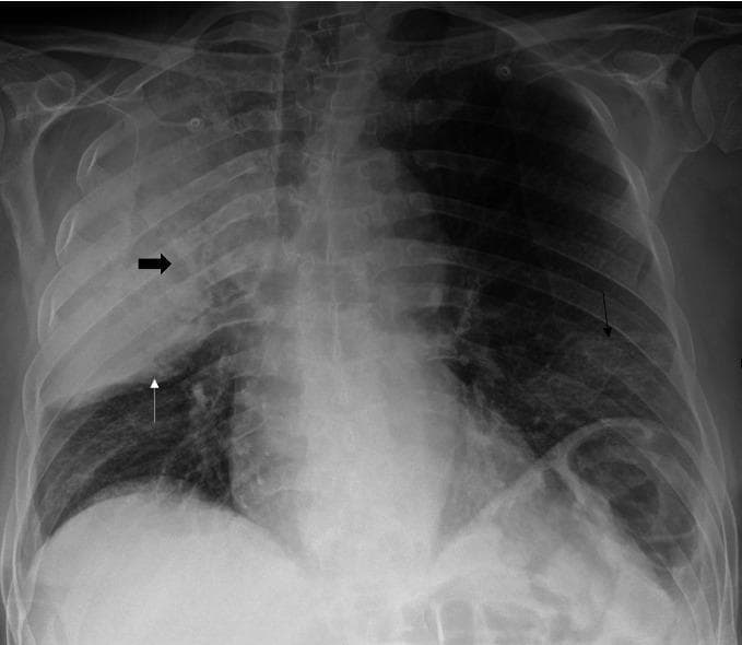 This chest X-ray in anteroposterior (AP) projection demonstrates multi-focal pulmonary pathology. The primary finding is a dense consolidation of the right upper lobe (RUL), characterized by a notable 'bulging fissure' sign where the horizontal fissure (marked by a thin white arrow) is displaced inferiorly, suggesting an expansive inflammatory process such as Klebsiella or Legionella pneumonia. Within the RUL consolidation, a thick black arrow points to an area of radiolucency representing pulmonary cavitation. Additionally, the image shows bilateral lower zone ground-glass opacities (indicated by a thin black arrow in the left lung base), manifesting as hazy increased density that does not fully obscure pulmonary vasculature. This combination of dense, cavitating lobar consolidation and diffuse ground-glass opacities is clinically significant for severe community-acquired or atypical pneumonia, potentially occurring in the context of co-infections such as SARS-CoV-2 and Legionella pneumophila. Educational value lies in identifying the bulging fissure sign, recognizing cavitary lesions on plain film, and distinguishing lobar consolidation from diffuse ground-glass patterns.