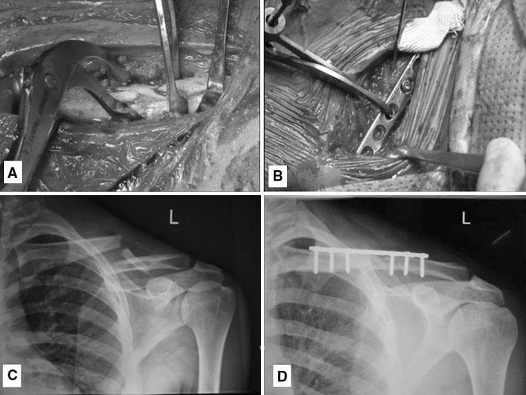 This composite educational image illustrates the surgical management of a midshaft clavicle fracture through plate osteosynthesis. Panels A and B are intra-operative clinical photographs. Panel A shows the fracture reduction phase, where surgical instruments (reduction clamps and retractors) are used to align the cortical bone fragments. Panel B demonstrates the fixation phase, showing a 3.5 mm dynamic compression plate (DCP) being contoured and secured to the superior aspect of the clavicle. Panels C and D are anteroposterior (AP) radiographs of the left shoulder. Radiograph C displays the preoperative displaced midshaft clavicle fracture with clear discontinuity and superior displacement of the medial fragment. Radiograph D is a 6-month post-operative follow-up showing successful fracture union and consolidation. The internal fixation hardware, consisting of a superiorly placed plate and six cortical screws, remains in situ with restored anatomical alignment. This sequence highlights the transition from acute injury to clinical recovery via open reduction and internal fixation (ORIF).