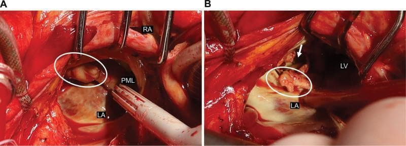 Two-panel intraoperative clinical photograph (A and B) showing findings during emergency cardiac surgery for infective endocarditis. Panel A illustrates the initial surgical view of the heart with annotations for the right atrium (RA), left atrium (LA), and posterior mitral leaflet (PML). A large, irregular, whitish-tan vegetation is highlighted within a white oval, attached to the mitral valve apparatus. Surgical retractors and a suction vent tube are visible in the field. Panel B shows the surgical site following the partial resection of the PML. The white oval indicates residual vegetation on the mitral annulus. A white arrow points to a pseudoaneurysm located on the posterior wall of the left ventricle (LV), which resulted from a perforated valve annulus abscess. The image demonstrates the destructive nature of bacterial endocarditis on cardiac valves and adjacent myocardial tissue. These frames serve as educational material for cardiac surgeons and residents to understand the intraoperative presentation of complicated mitral valve endocarditis and associated paravalvular complications.