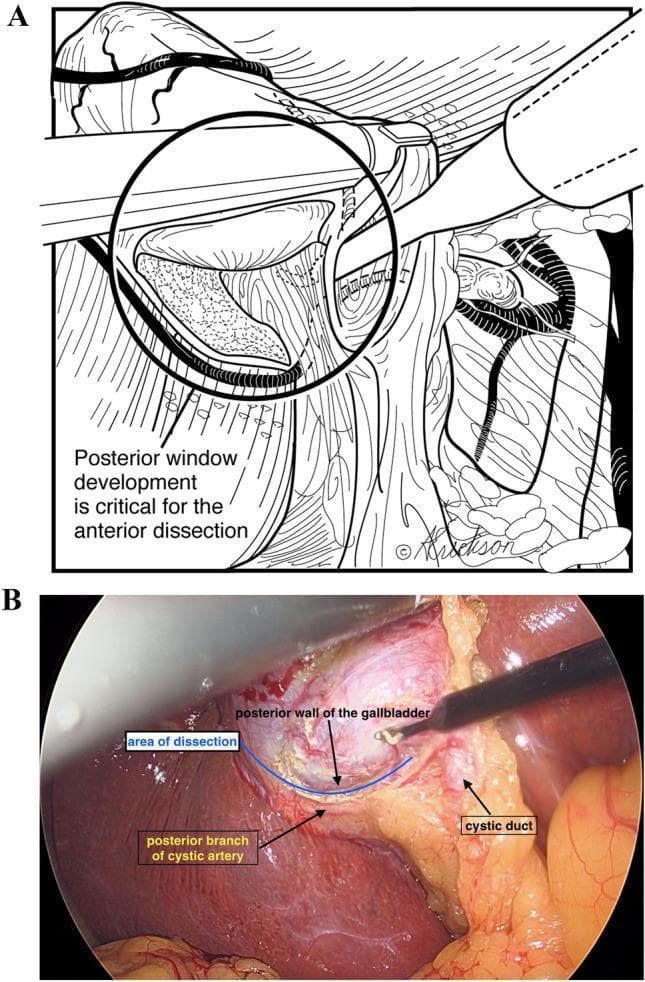 This composite image illustrates a critical step in laparoscopic cholecystectomy, specifically the development of the 'posterior window.' Panel A is an anatomical line diagram highlighting that posterior window development is essential for safe anterior dissection. Panel B is a corresponding intra-operative endoscopic photograph showing the surgical field in the hepatocystic triangle (Triangle of Calot). The photo identifies key structures: the posterior wall of the gallbladder, the cystic duct, and the posterior branch of the cystic artery. A surgical instrument is seen performing dissection in the avascular plane between these structures, labeled as the 'area of dissection.' This step facilitates the circumferential mobilization of the gallbladder infundibulum while protecting the biliary and vascular anatomy. The visualization emphasizes the importance of identifying the posterior cystic artery branch relative to the gallbladder wall to avoid inadvertent injury to the right hepatic artery or common bile duct during the attainment of the Critical View of Safety.
