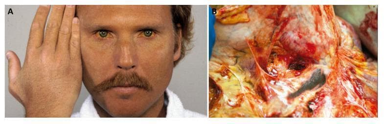 This composite educational image illustrates clinical and pathological features of hereditary hemochromatosis.
Image A is a clinical photograph of a male patient demonstrating generalized skin hyperpigmentation, often referred to as 'bronze' coloration. A side-by-side comparison with the patient’s own hand highlights the marked contrast between the tanned, metallic hue of the facial skin and a more typical Caucasian skin tone. The sclerae also appear to show slight icteric or pigmented changes.
Image B is a gross pathology photograph showing a dissected organ, the pancreas, which exhibits a characteristic dark, black-greyish discoloration. This color change is a result of extensive parenchymal iron deposition (hemosiderosis) common in advanced iron overload syndromes. The tissue appears rigid and shows signs of inflammatory disruption, surrounded by vascular congestion and fluid.
Together, these images illustrate 'bronze diabetes,' the classic triad of hyperpigmentation, diabetes mellitus (via pancreatic damage), and cirrhosis associated with chronic iron overload in hereditary hemochromatosis.