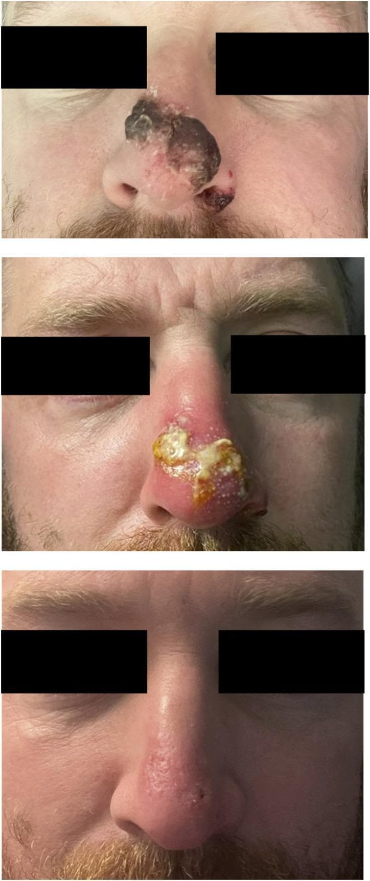 A series of three clinical photographs arranged vertically, documenting the progression and resolution of a secondary bacterial infection complicating a primary mpox lesion on the nose. The top image (Day -1) shows a large, dark, necrotic-appearing plaque with irregular borders and central ulceration covering the nasal bridge and tip. The middle image (Day 5) illustrates the inflammatory phase, characterized by intense peri-lesional erythema, edema, and a thick, yellow purulent exudate/crust indicative of secondary infection. The bottom image (Day 13) demonstrates significant clinical resolution following treatment, with the nose showing only residual mild erythema and subtle textural irregularities where the primary lesion was located. This timeline emphasizes the evolution from acute necrotic infection and secondary bacterial complication to successful healing and tissue remodeling in the context of viral dermatopathology.