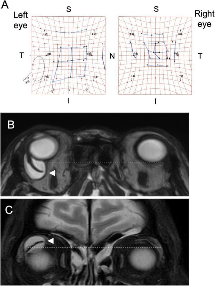 This composite educational image illustrates diagnostic findings for a mechanical strabismus complication following Ahmed Glaucoma Valve (AGV) implantation. Panel A displays a Hess Screen chart, a clinical ophthalmological tool used to map ocular motility. The chart shows a constricted field for the right eye (OD), indicating esotropia and hypotropia in the primary position with restricted infraduction and adduction, while the left eye (OS) demonstrates compensatory enhanced movements. Panels B and C show T2-weighted magnetic resonance imaging (MRI) of the orbits. Panel B (axial view) reveals a large, posteriorly enlarged giant bleb (high T2 signal) in the right superotemporal quadrant, causing anterior displacement of the eyeball compared to the contralateral side (indicated by a dotted reference line). The AGV plate is visible as a low-intensity signal (arrowhead). Panel C (coronal view) demonstrates the superior-to-inferior extent of the bleb, which causes inferior displacement of the right globe. These visuals effectively teach the relationship between physical mass effect from glaucoma drainage devices and restrictive motility disturbances.