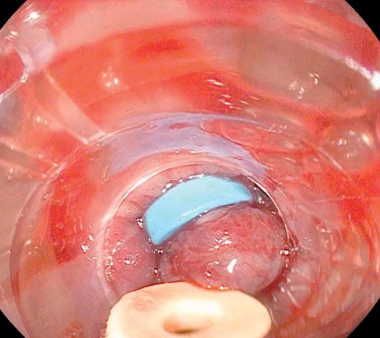 This clinical photograph shows an endoscopic view of an upper gastrointestinal procedure focused on the management of esophageal varices. The image depicts the esophageal lumen through a transparent plastic banding cap attached to the end of the endoscope. Within the center of the field, a large, reddish-pink, distended varix is visible. A bright blue elastic ligation band is seen partially encircling the base of the variceal tissue, demonstrating a key step in Endoscopic Variceal Ligation (EVL). The tissue appears congested and irregular, characteristic of portal hypertension. The banding cap is positioned to provide suction and visualization, facilitating the mechanical ligation process. This procedural image illustrates the technique of band-on-band ligation, where a secondary band is applied to ensure hemostasis and secure tissue prolapse when initial placement is suboptimal. The medical domain is Gastroenterology, and the target audience is intermediate-to-advanced medical students and surgical residents specializing in endoscopic interventions for GI bleeding.