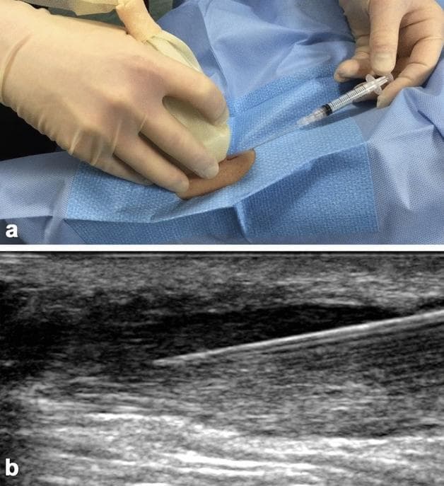 This composite educational image illustrates an ultrasound-guided stem cell injection for Achilles tendinosis. (a) A clinical photograph showing the sterile intraoperative setup where a practitioner, wearing sterile gloves, uses a high-frequency linear ultrasound probe (covered in a sterile sheath) to visualize the target area while inserting a syringe needle. The anatomical region is prepared with sterile blue drapes. (b) A corresponding longitudinal greyscale ultrasound image demonstrating the 'in-plane' needle technique. The needle appears as a distinct hyperechoic (bright) linear structure. It is positioned within a localized area of low reflectivity (hypoechoic) in the superficial portion of a thickened Achilles tendon, characteristic of focal tendinosis. The image captures the procedural moment of injection performed while withdrawing the needle distal-to-proximal through the disorganized fibrous tissue. This visual serves as a teaching tool for musculoskeletal interventional radiology, highlighting real-time imaging guidance to ensure precise delivery of biologics like bone marrow-derived mesenchymal stem cells (BMMSCs) into chronic tendon lesions.