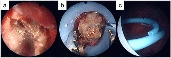 Endoscopic view of a percutaneous nephrolithotomy (PCNL) procedure, segmented into three clinical frames (a, b, and c). Frames a and b demonstrate the intra-renal management of a large renal calculus. The stone is light brown with a rough, crystalline texture, characteristic of calcium oxalate calculi. In frame a, a pneumatic lithotripter probe is applied directly to the stone surface for fragmentation. Frame b shows the use of metallic stone-grasping forceps to manipulate or extract fragmented stone pieces within the renal collecting system. Frame c depicts the placement of a flexible, light-blue ureteral stent or drainage tube, featuring dark graduation markings and a distinct distal lumen. The background shows the hyperemic mucosal lining of the renal pelvis. These images illustrate the key stages of PCNL: endoscopic stone identification, fragmentation, and post-procedural drainage in a patient with a complex renal anatomy, such as a horseshoe kidney.