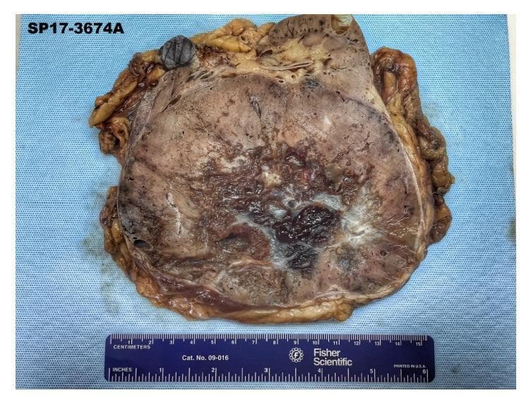 This clinical photograph displays a gross pathology specimen of a bivalved right kidney. The specimen is dominated by a large, well-circumscribed, spherical mass that has almost entirely replaced the renal parenchyma. The cut surface of the tumor exhibits a characteristic mahogany or maroon-colored, homogenous appearance. A prominent, stellate, gray-white fibrous scar is visible in the central region of the mass, radiating outward. These gross findings—a mahogany-brown color and a central stellate scar—are classic diagnostic hallmarks of a renal oncocytoma. The mass is encapsulated, and the surrounding perinephric fat is visible at the margins. A metric ruler at the bottom of the frame provides scale, indicating the significant size of the lesion, which corresponds to the clinical presentation of a large renal mass. This specimen serves as a primary educational example of benign renal neoplasm morphology in urologic pathology.