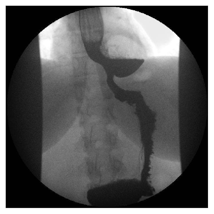 This diagnostic image is a barium swallow radiograph (fluoroscopy) of the upper gastrointestinal tract, focusing on the thoracic esophagus. The image shows a prominent, radiopaque curvilinear structure representing the esophagus opacified with barium contrast. A large, saccular outpouching or epiphrenic diverticulum is visible in the distal esophagus, extending laterally. A distinct horizontal air-fluid level is demonstrated within the diverticulum, characterized by a radiolucent (darker) gas-filled superior portion and a radiopaque (lighter) fluid/contrast-filled inferior portion. The distal esophageal lumen appears narrowed inferior to the diverticulum, and there is evidence of mucosal irregularity and proximal reflux of contrast material. The surrounding anatomical context includes visible vertebral bodies of the thoracic spine and the faint silhouette of the diaphragm. This image serves as a classic educational example of an esophageal diverticulum and associated stasis, useful for demonstrating diagnostic imaging findings in patients presenting with chronic dysphagia and regurgitation.