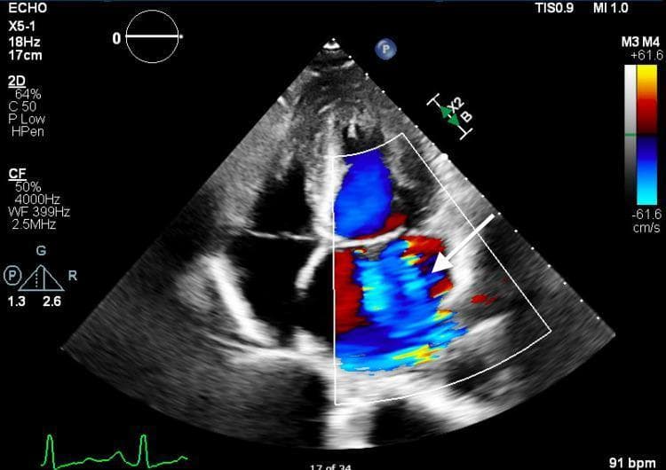 This diagnostic image is a transthoracic echocardiogram (TTE) in an apical four-chamber view with color flow Doppler. The image demonstrates severe (torrential) mitral regurgitation. A large, prominent mosaic-colored jet, indicated by a white arrow, originates at the mitral valve and extends deeply into the left atrium during systole. The mosaic pattern (a mix of red and blue hues) signifies turbulent, high-velocity flow. The color Doppler box covers the left ventricle (bottom) and the left atrium (top), showing flow directed away from the transducer into the atrium. This visual finding is a classic representation of significant valvular pathology, specifically mitral regurgitation due to valve incompetence, used in cardiology education to teach the assessment of regurgitant jet area and severity.