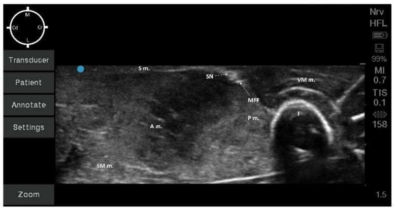 This diagnostic image is a transverse ultrasound of the medial mid-thigh region, illustrating the musculoskeletal and neurovascular anatomy relevant for regional anesthesia. The femur (F) is identified by a prominent hyperechoic curvilinear border with characteristic posterior acoustic shadowing. Cranial to the femur is the vastus medialis muscle (VM m.), while the pectineus (P m.), adductor (A m.), and semimembranosus (SM m.) muscles occupy the deeper and caudal fields, exhibiting heterogeneous echogenicity. Superficially, the sartorius muscle (S m.) covers the neurovascular compartment. A critical landmark is the medial femoral fascia (MFF), visualized as a hyperechoic fascial plane containing the saphenous nerve (SN). The SN appears as a small, hyperechoic, round-to-oval structure within this fascia. Orientation markers indicate medial (M), lateral (L), cranial (Cr), and caudal (Cd) directions. This ultrasound view is clinically significant for performing ultrasound-guided saphenous nerve blocks, allowing for precise needle localization and local anesthetic deposition within the fascial plane.