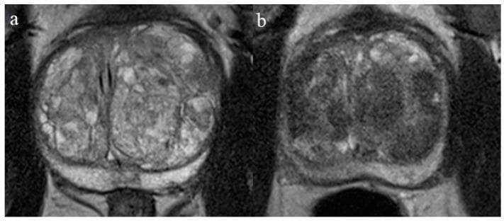 Comparison of pre- and post-treatment axial T2-weighted turbo spin echo (TSE) magnetic resonance imaging (MRI) of the prostate. Image (a) shows Benign Prostatic Hyperplasia (BPH) with a significantly enlarged prostate gland. There is a prominent, heterogeneous, hyperintense adenoma in the transition zone, particularly in the left lobe, which is seen compressing and displacing the prostatic urethra. Image (b) shows the same patient three months following prostatic artery embolization (PAE). The follow-up scan demonstrates a marked reduction in prostate volume and a diffuse decrease in T2 signal intensity within the treated areas. This global T2-hypointensity and more homogeneous texture correspond to tissue infarction and subsequent fibrosis of the prostatic adenoma. The compression on the prostatic urethra is visibly relieved compared to the baseline image. This diagnostic comparison illustrates the efficacy of minimally invasive interventions in reducing glandular volume and altering tissue composition in symptomatic BPH.
